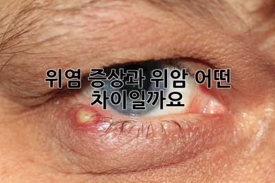 위염 증상과 위암, 어떤 차이일까요?